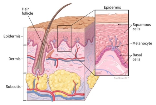 Skin cancer image
